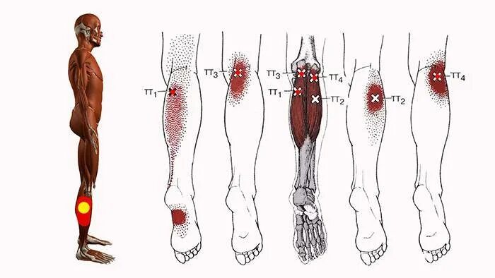 Триггерные точки икроножной мышцы. Триггерные точки ноги голени. Триггерные точки большеберцовой мышцы. Мышцы икр триггерные точки.