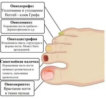Постоянно болят пальцы ног