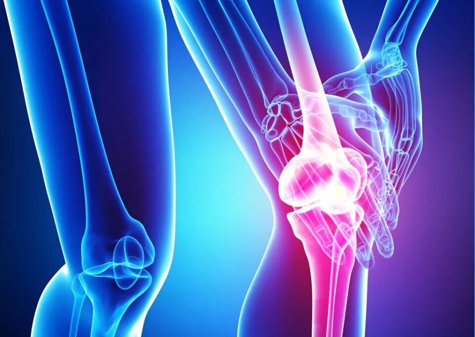 Медицина артриты. Ревматизм коленного сустава.