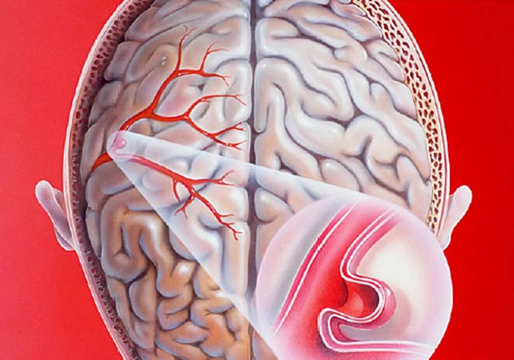 Внутричерепная аневризма. Микроаневризма сосудов головного мозга. Аневризма артерии головного мозга. Аневризмы сосудов головного мозга клиника. Расширение сосудов головы