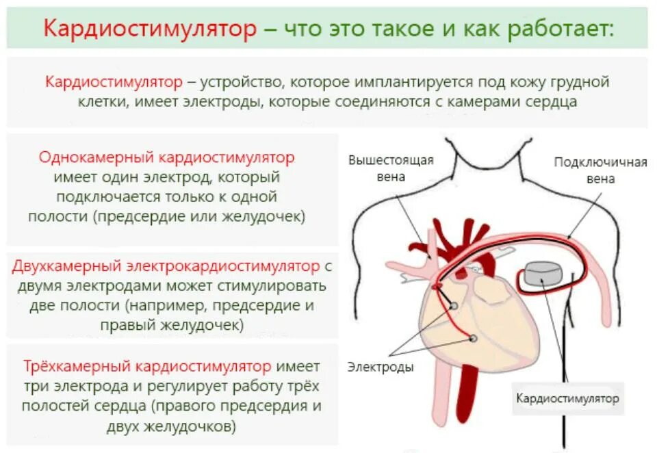 Как работает стимулятор для сердца. Схема установки кардиостимулятора. Кардиостимулятор сердца. Виды электрокардиостимуляторов.