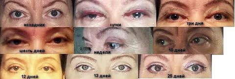 Сколько дней сходит отек