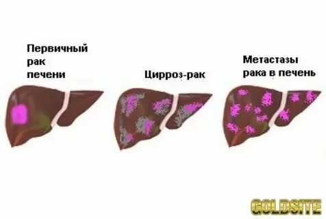 Метастазы в печени прогноз 4 стадия выживаемость