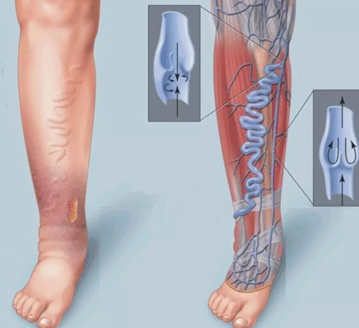 Хроническая венозная недостаточность (ХВН). Варикозное расширение вен нижних конечностей ХВН. Варикозное расширение вен нижних конечностей ХВН с2 3s. Тромбоз сосудов нижних