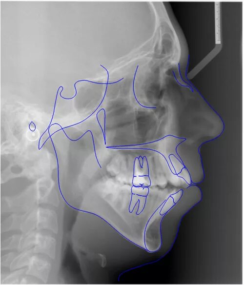 Цефалометрия внчс. Цефалометрия внчс. Цефалометрический анализ трг. Кт двух челюстей и внчс 3d-цефалометрия. Planmeca romexis рентген.