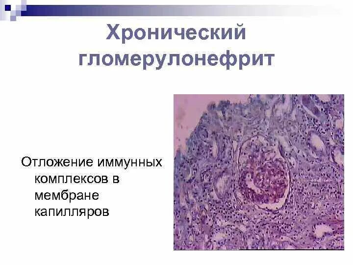 Болезнь почек гломерулонефрит. Серозный гломерулонефрит патанатомия. склерозирующий гломерулонефрит гистология. гломерулонефрит патанатомия. диффузный гломерулонефрит патанатомия.