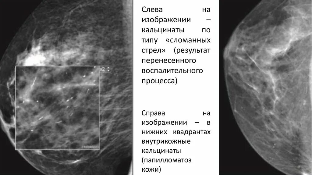 Округлые кальцинаты. Маммография микрокальцинаты. Кальцинаты маммограмма. Линейные кальцинаты маммография. Кальцинаты на маммографии.