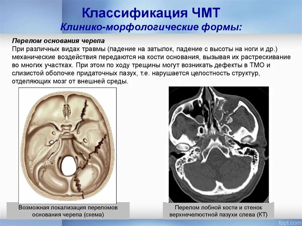 Для перелома основания черепа характерно. Перелом костей основания черепа. При переломе основания черепа. Черепно мозговая травма перелом основания черепа. Перелом основания черепа признаки.