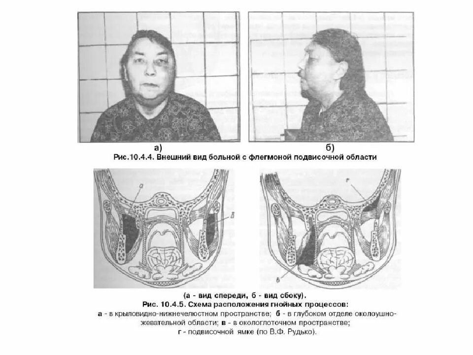 Абсцесс желобка. Флегмона челюстно-лицевой области абсцесс челюстно. флегмона дна нижней челюсти. окологлоточная флегмона. одонтогенная флегмона поднижнечелюстной.