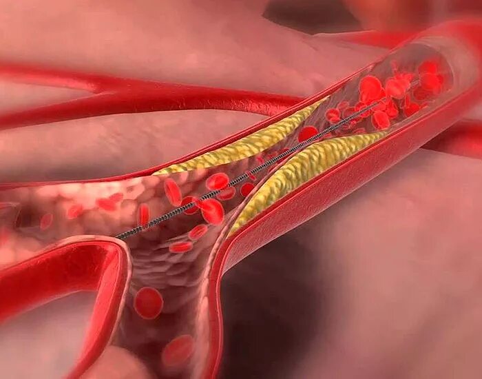 Баллонная ангиопластика артерий. Баллонная ангиопластика сосудов почки. Эндоваскулярная ангиопластика. ТРАНСЛЮМИНАЛЬНАЯ коронарная ангиопластика. Ангиопластика цена