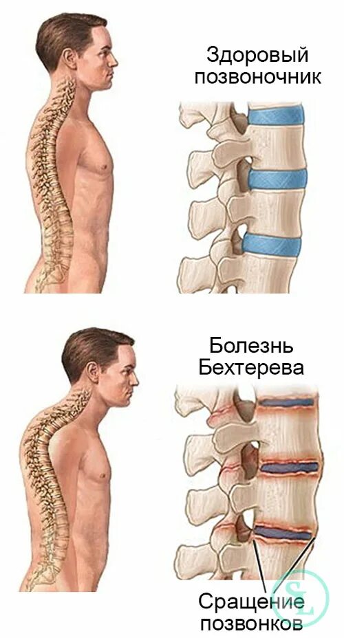 Анкилозирующий спондилит болезнь Бехтерева. Болезнь Бехтерева или анкилозирующий спондилоартрит;. Болезнь Бехтерева грудного отдела позвоночника. Болезнь Бехтерева поясничный отдел позвоночника.