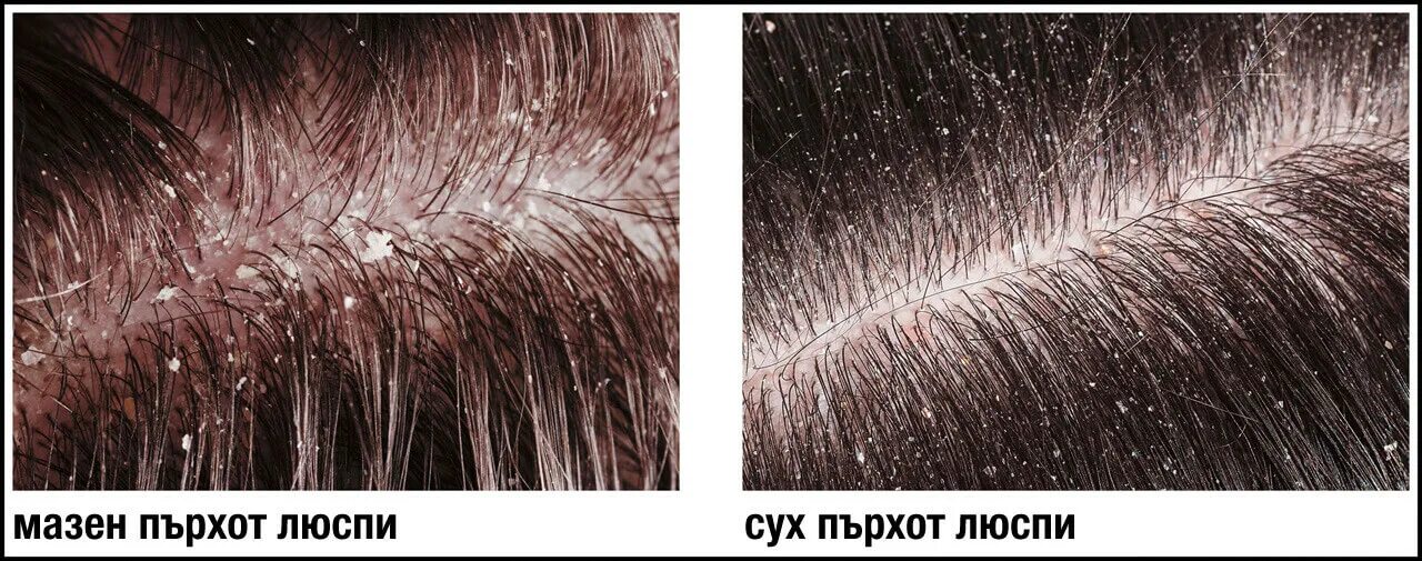Как избавиться от перхоти навсегда