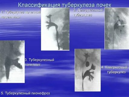 Туберкулезный папиллит