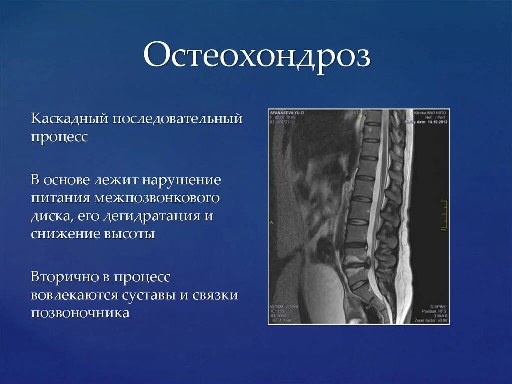 Мрт шейного отдела позвоночника остеохондроз. Дегидратация диска позвоночника. Остеохондроз позвоночника кт. Остеохондроз мрт.