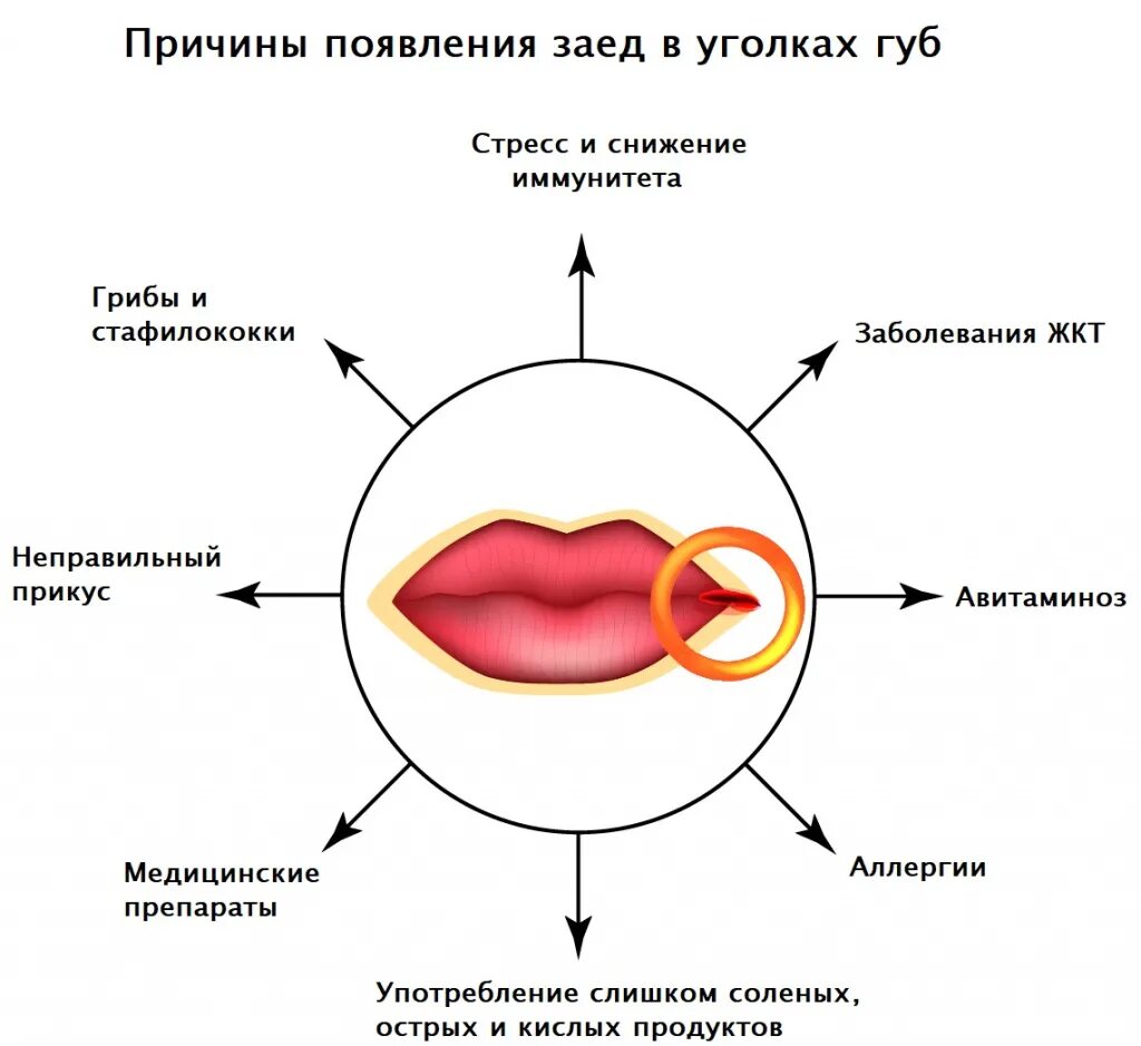 Заеды в уголках рта причины.