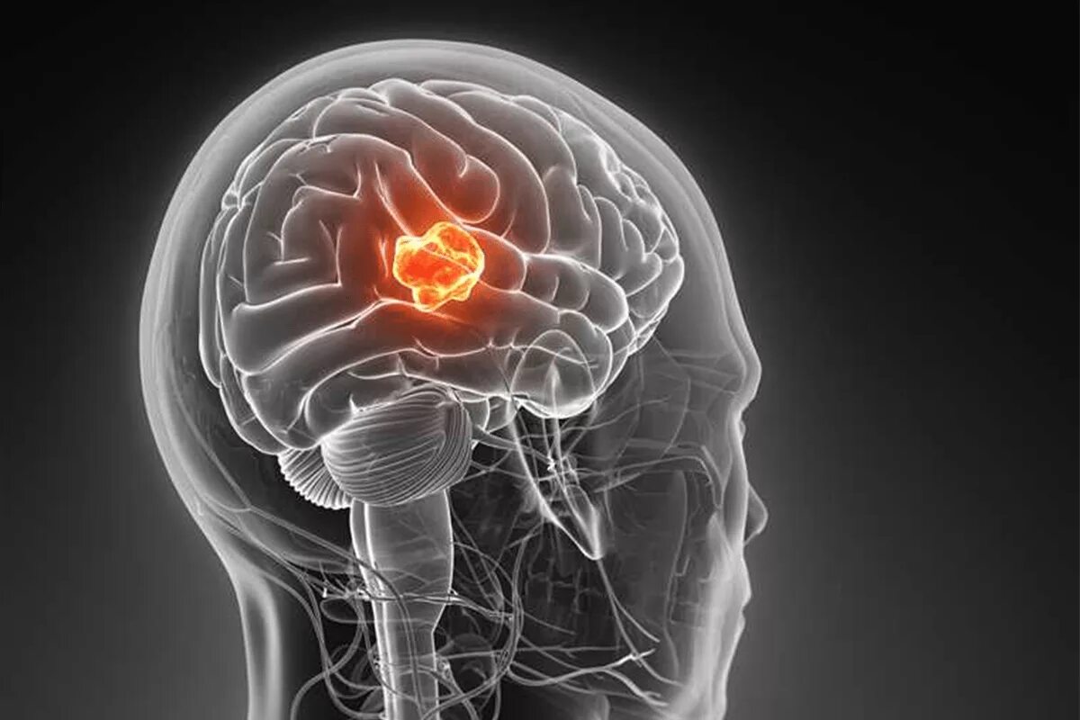 Опухоли центральной нервной системы. Злокачественное новообразование головного мозга. Лечение рака головного мозга