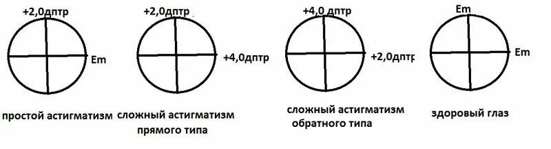 Астигматизм миопический простой обратный. Сложный миопический астигматизм степенью 1.0д. Сложный миопический астигматизм обратного типа обоих глаз. Сложный миопический астигматизм типы.