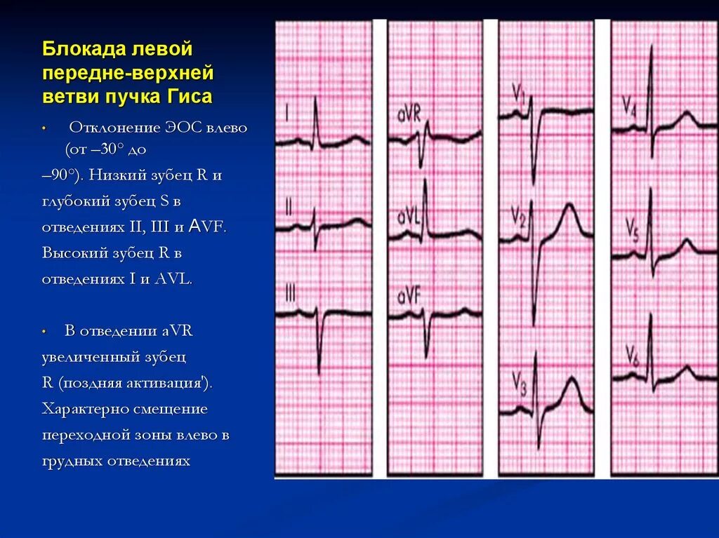 Блокада передне лнпг. Блокады ветвей пучка Гиса на ЭКГ. Блокада левой передней ветви пучка Гиса. Неполная блокада передней ветви ЛНПГ на ЭКГ. Блокада левой ножки пучка Гиса ЭКГ 2 отведение.