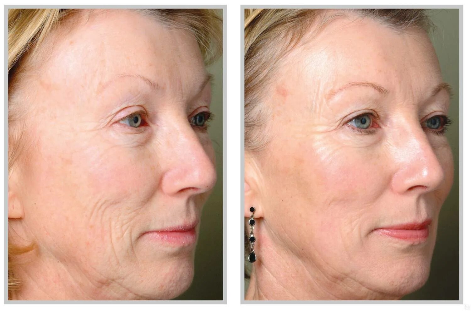 Tattoo Removal ashland Ky Beautiful Laser Skin Resurfacing Richmond Va Spider Ve
