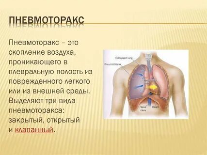 Пневмоторакс это