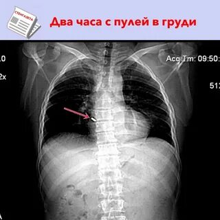 В грудной клетке инородное