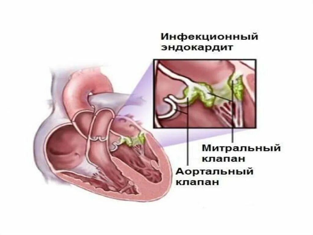 Инфекционный эндокардит это. Инфекционный эндокардит клапаны. Инфекционный септический эндокардит. Инфекционный эндокардит митрального клапана. Септический эндокардит митрального клапана.