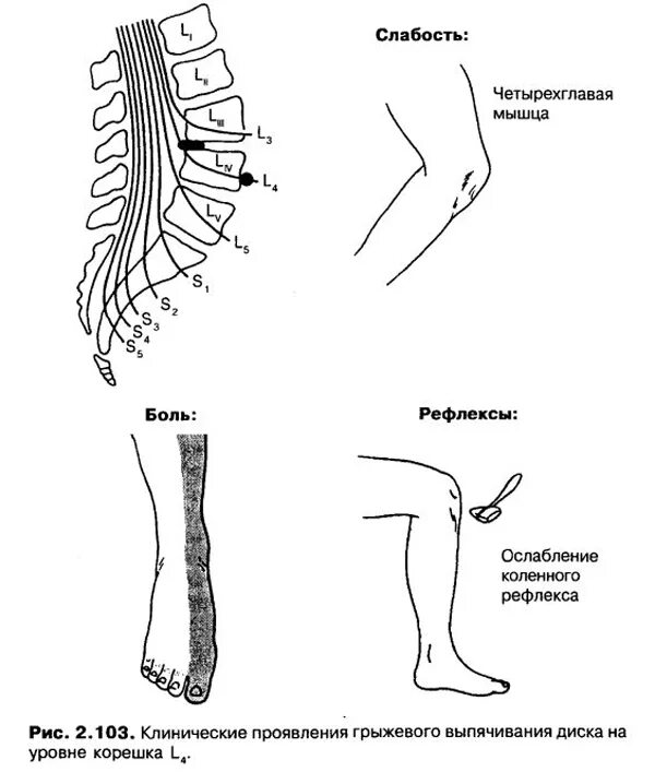 Поражение корешковых нервов. Компрессия корешка l3. Корешковый синдром л5. Корешковые синдромы l1-l3. Синдром компрессии s1 корешка справа.