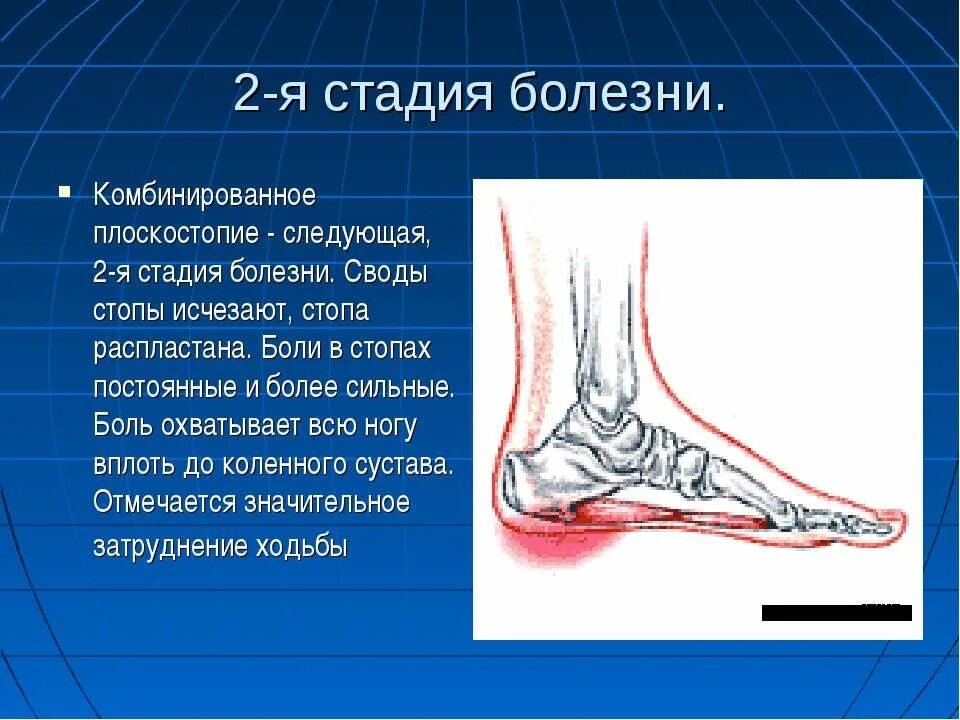 Болят своды стопы ног. Свод стопы плоскостопие. Продольно поперечное комбинированное плоскостопие 2-3 степени. Плоскостопие высота свода стопы. Стопа комбинированное плоскостопие.