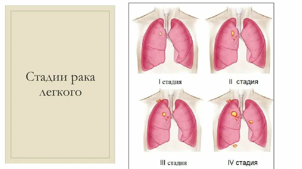 Стадии онкологии легкого. Онкология лёгких 4 стадия. Онкология легких стадии. Рак 4 стадии без лечения