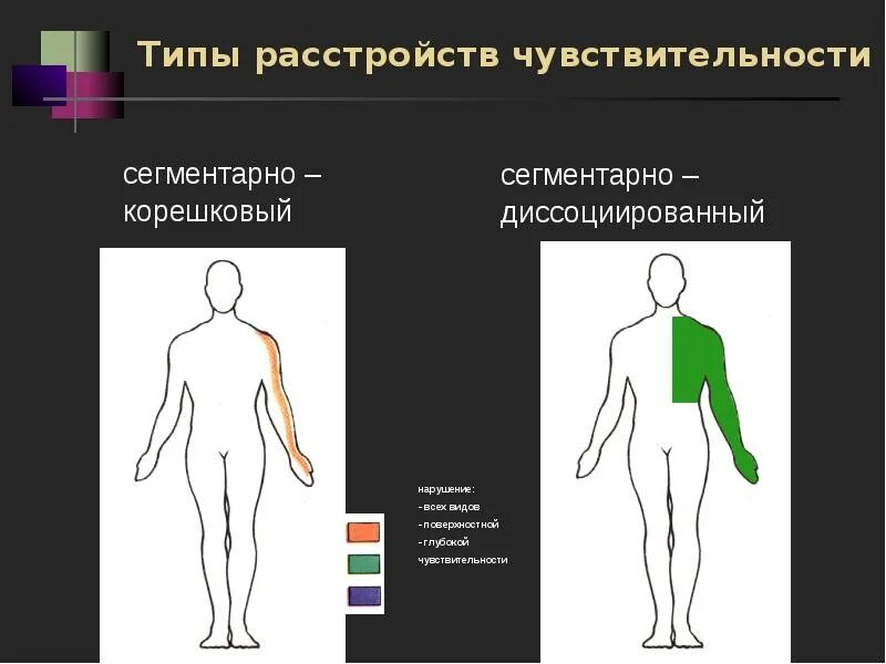 Сегментарный диссоциированный тип нарушения чувствительности. Сегментарно-диссоциированный тип расстройства чувствительности. чувствительность нарушения чувствительности неврология. корешково сегментарный тип расстройства чувствительности. периферический корешковый тип нарушения чувствительности.