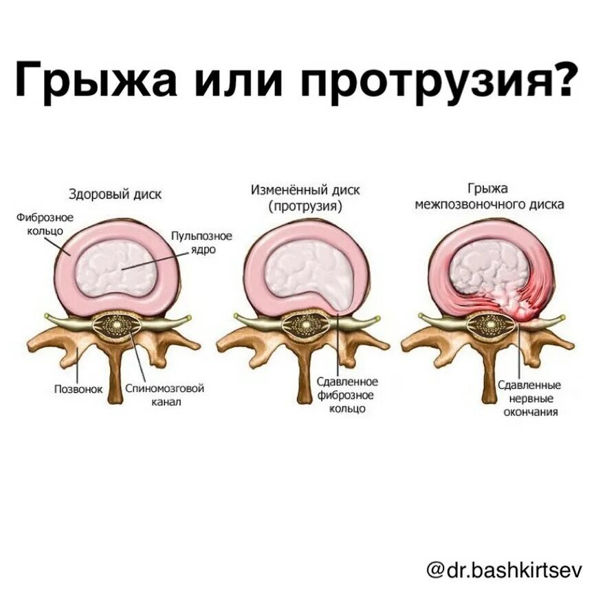 Массаж грыжи и протрузии. Фиброзное кольцо межпозвоночного диска. протрузия межпозвоночного диска. грыжа межпозвонкового диска. грыжи и протрузии позвоночника.