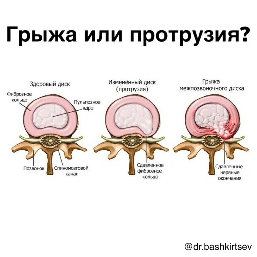 Фиброзное кольцо межпозвоночного диска. Протрузия межпозвоночного диска. Грыжа межпозвонкового диска. Грыжи и протрузии позвоночника.