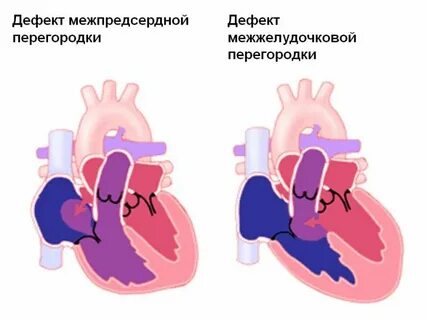 Пороки перегородки сердца