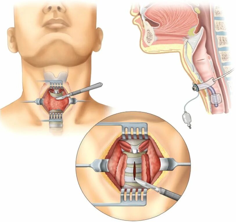 Трахеостомия трубка дыхательная. Трахеостома - Стома трахеи.. Трахеостомическая трубка в горле. Что значит тяжелая операция