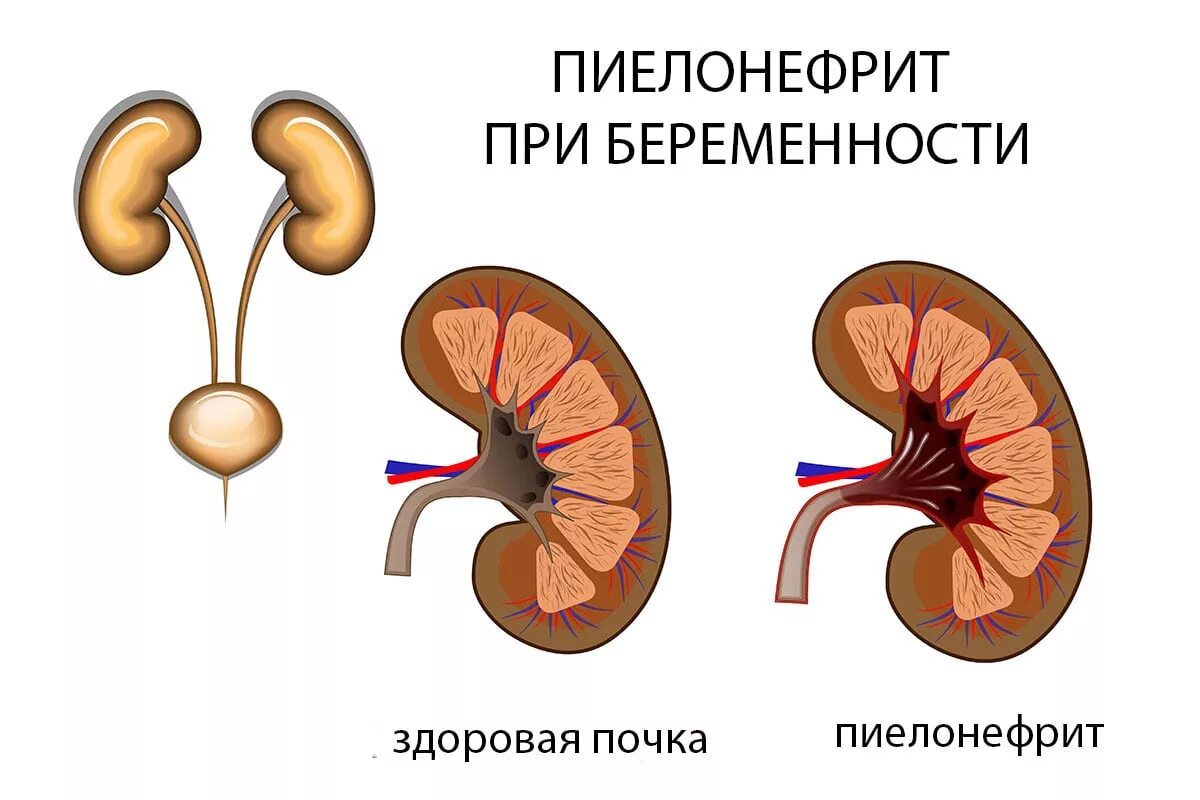 Как называется воспаление почек. Восходящий пиелонефрит. воспаление почек пиелонефрит. больные почки пиелонефрит. урогенный восходящий пиелонефрит.