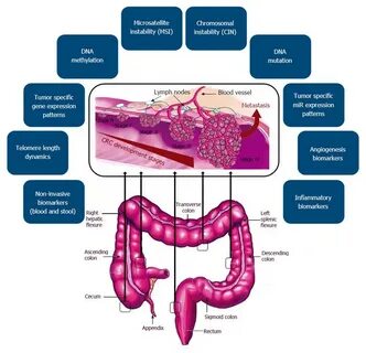 Colorectal cancer