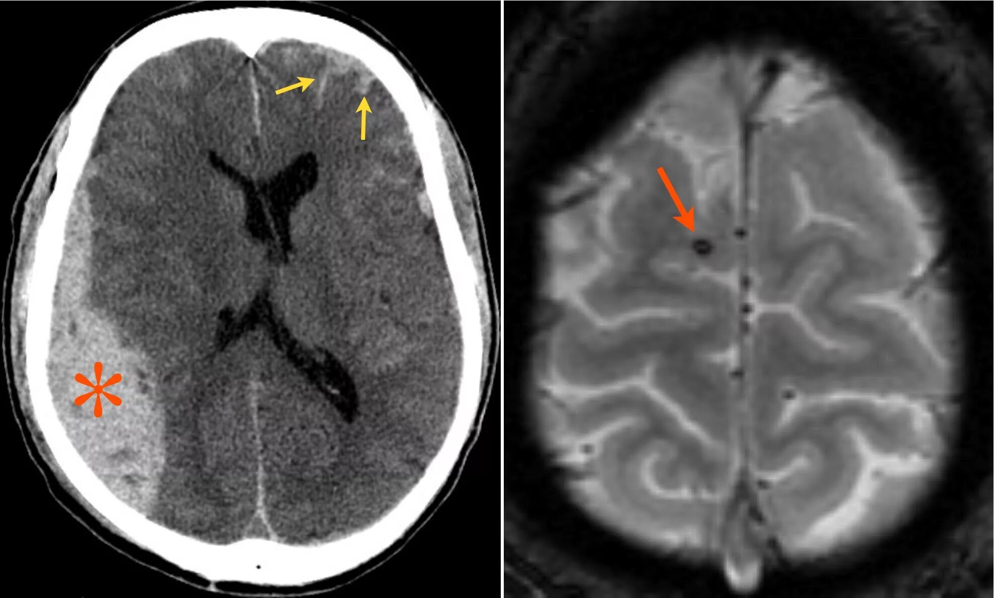 Сотрясение мозга томография. Сотрясение головного мозга на мрт. Черепно мозговая травма мрт. Сотрясение головного мозга на мрт. Сотрясение головного мозга на мрт.