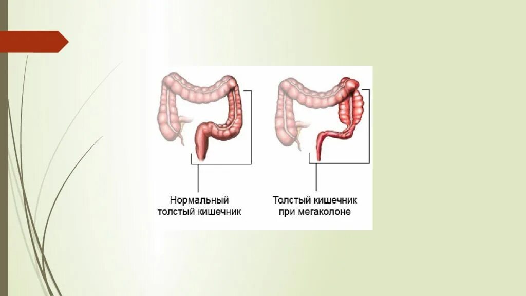 Сильные боли при колите