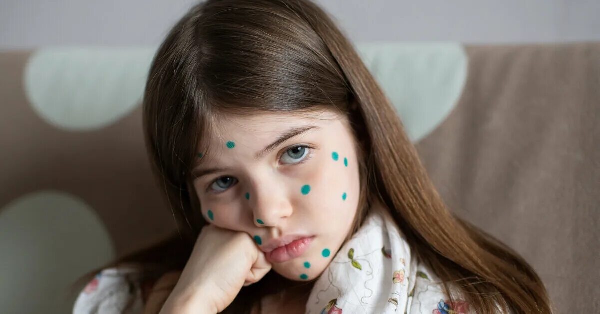 Картинки VARICELLA VIRUS