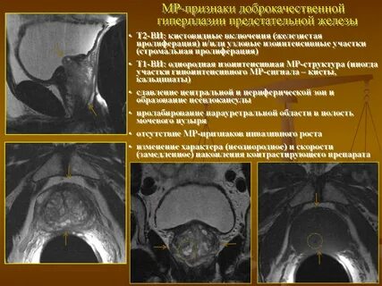 Диагноз предстательной железы