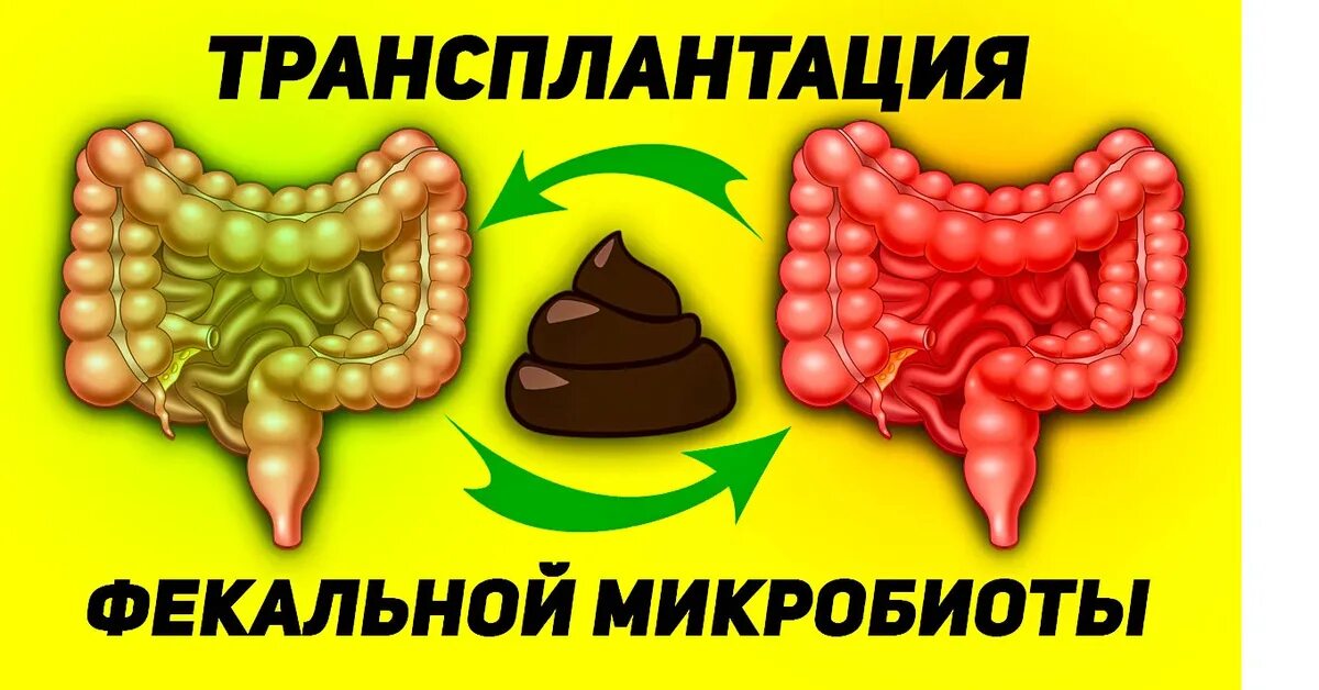 Трансплантация фекалий. Трансплантация фекальной микрофлоры. Фекальная трансплантация. Фекальный трансплантат. Фекальная трансплантация.