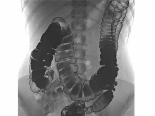 Птоз поперечно ободочной кишки рентген. Колоноптоз толстой кишки симптомы. Трансверзоптоз кишечника рентген. Поперечная ободочная кишка рентген.