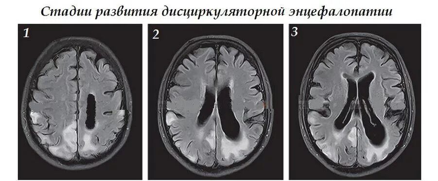 Поражение головного мозга у взрослых. Дисциркуляторная энцефалопатия мрт. Дисциркуляторная энцефалопатия головного мозга на кт. Гипертензивная энцефалопатия мрт. Дисметаболическая энцефалопатия мрт.