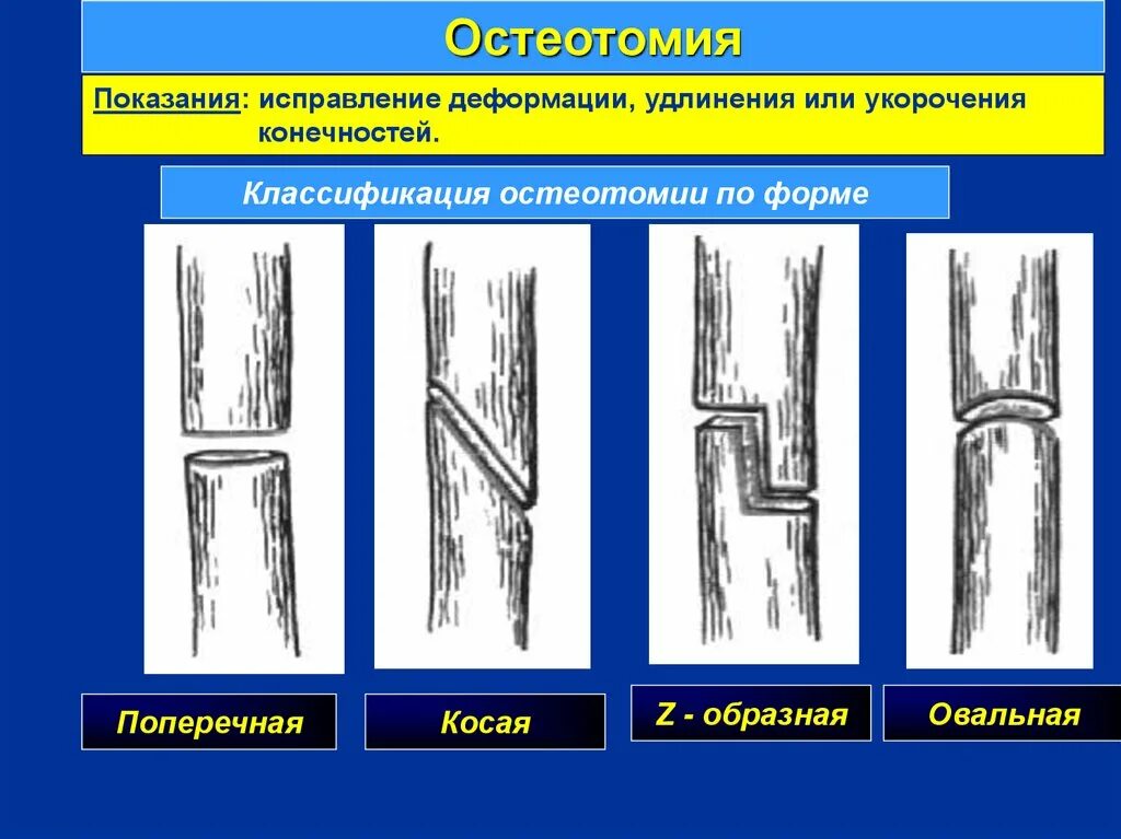 Виды остеотомии. Остеотомия классификация. Поперечная остеотомия. Операции на костях. Остеотомия. Способ удлинить