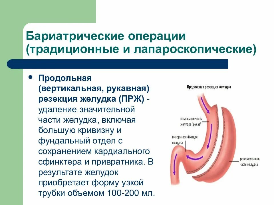 Резекция желудка анемия. Вертикальная рукавная резекция желудка. Лапароскопическая продольная «рукавная» резекция желудка. Бариатрия резекция желудка. Продольная резекция желудка бариатрической операции.