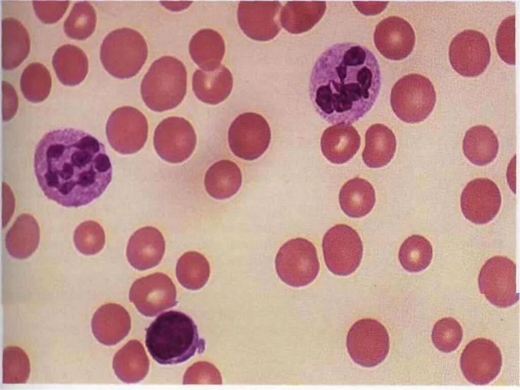 Аномалия лейкоцитов. Аномалия лейкоцитов. Токсогенная зернистость нейтрофилов. Патологические формы лейкоцитов. Патология системы лейкоцитов.