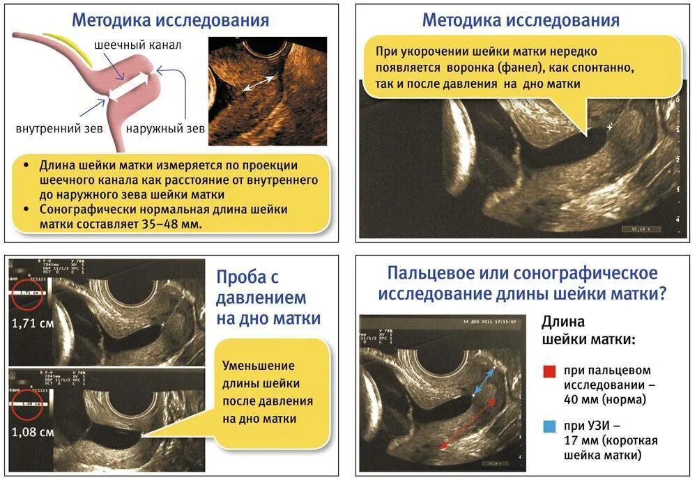 Почему укорачивается матка. Расположение шейки матки на ранних сроках. Нормальное расположение шейки матки. Положение шейки матки при беременности. Расположение шейки при беременности.