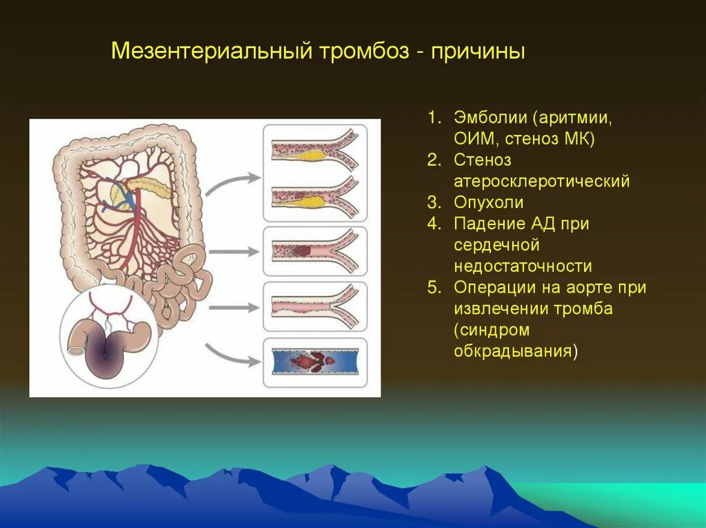 Мезентериальный атеросклероз. Мезентериальный тромбоз. Мезентеральный тромбо. Причины мезентериального тромбоза. Мезентериальный тромбоз мкб 10