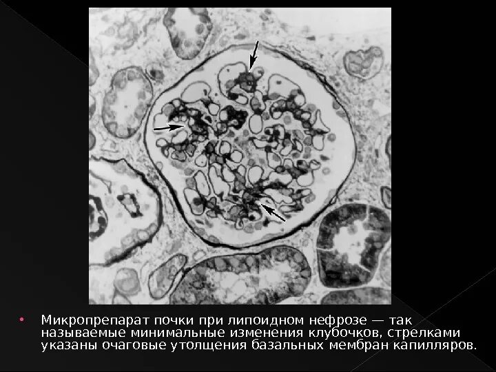 Очаговые изменения почки. Амилоидно-липоидный нефроз. Амилоидный нефроз макропрепарат. Электронограмма амилоидоз почечного клубочка.