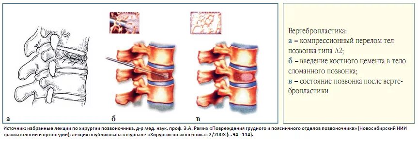 Перелом грудного позвонка код. Классификация компрессионных переломов тел позвонков. компрессионный перелом позвоночника типа 1. виды компрессионных переломов позвоночника. компрессионный перелом тела классификация.